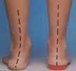 READY MADE ORTHOTICS.