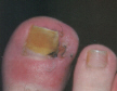 INGROWN TOENAIL