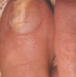 FUNGAL INFECTION OF THE NAIL.